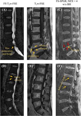 Evaluation of spine disorders using high contrast imaging of the cartilaginous endplate